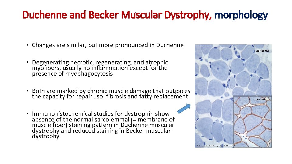 Duchenne and Becker Muscular Dystrophy, morphology • Changes are similar, but more pronounced in