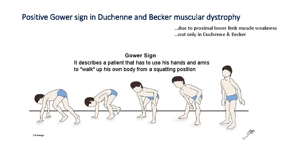 Positive Gower sign in Duchenne and Becker muscular dystrophy …due to proximal lower limb