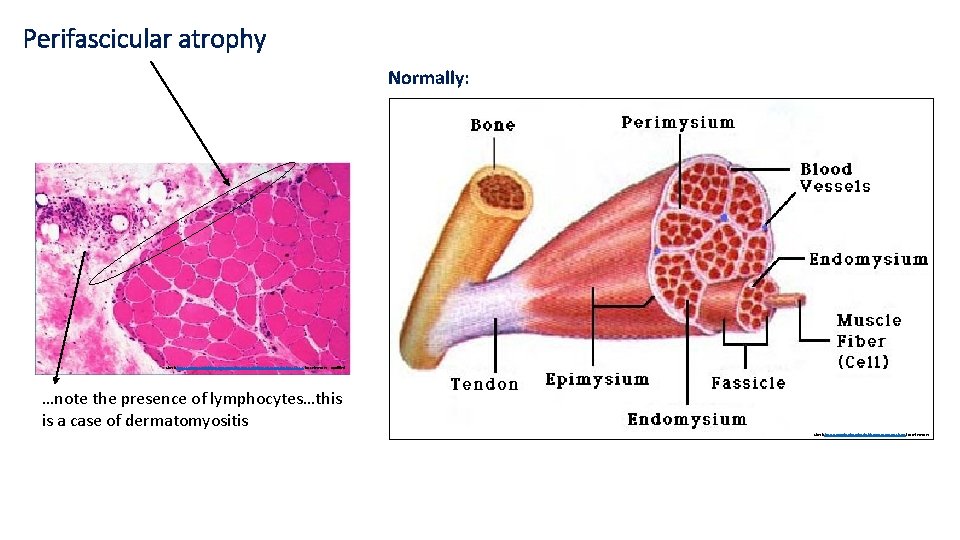 Perifascicular atrophy Normally: Check https: //www. studyblue. com/notes/note/n/pathology-pictures/deck/6713881 for references. . . modified …note