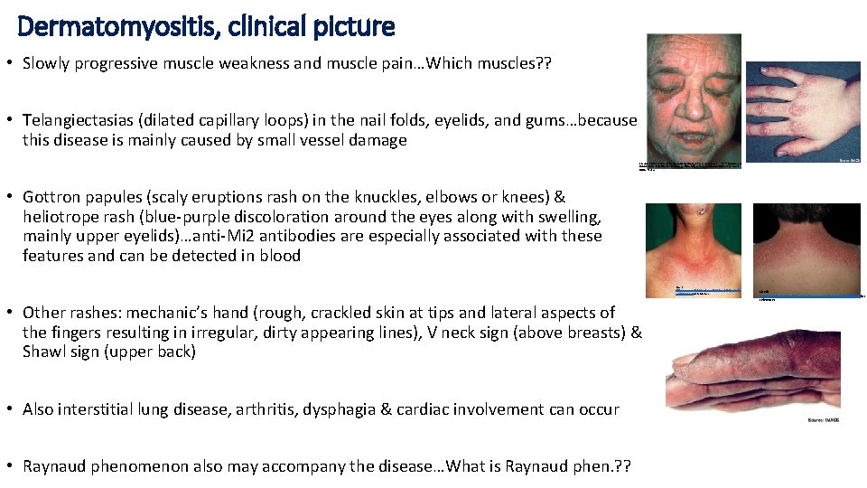 Dermatomyositis, clinical picture • Slowly progressive muscle weakness and muscle pain…Which muscles? ? • Dermatomyositis, clinical picture • Slowly progressive muscle weakness and muscle pain…Which muscles? ? •