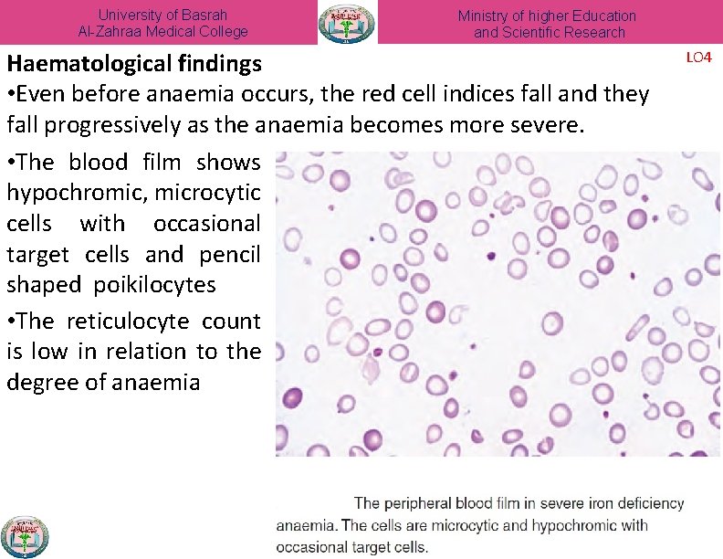 University of Basrah Al-Zahraa Medical College Ministry of higher Education and Scientific Research Haematological