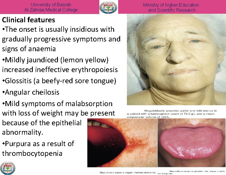 University of Basrah Al-Zahraa Medical College Clinical features • The onset is usually insidious