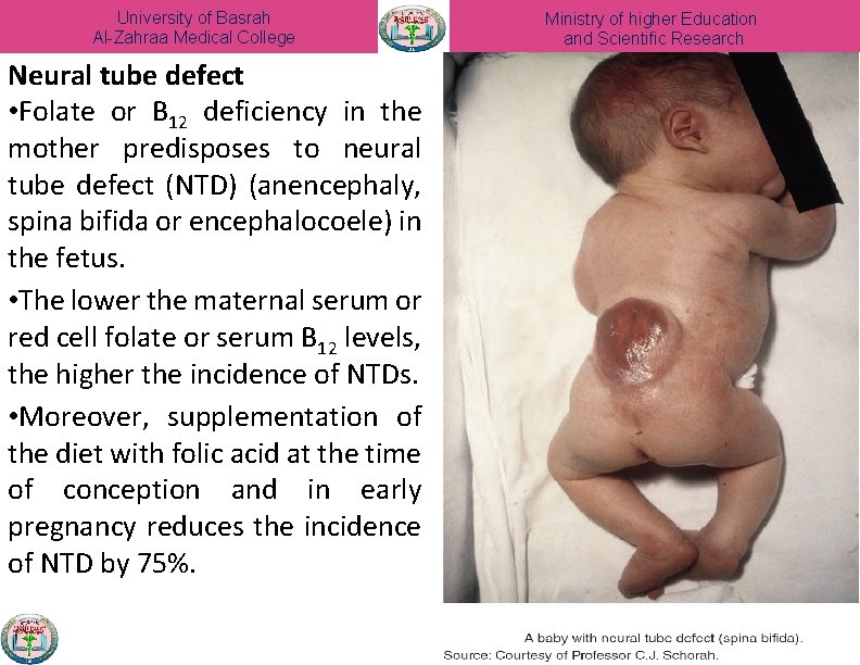 University of Basrah Al-Zahraa Medical College Neural tube defect • Folate or B 12
