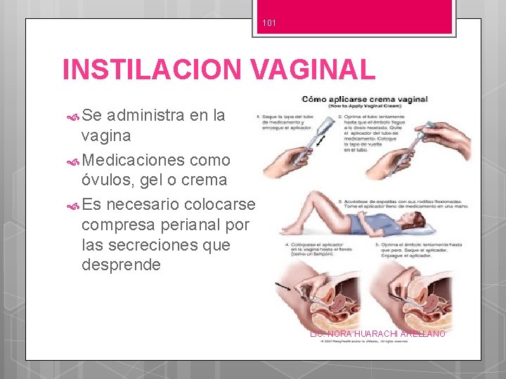 101 INSTILACION VAGINAL Se administra en la vagina Medicaciones como óvulos, gel o crema