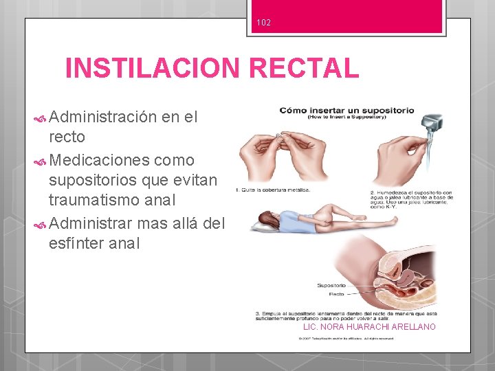 102 INSTILACION RECTAL Administración en el recto Medicaciones como supositorios que evitan traumatismo anal