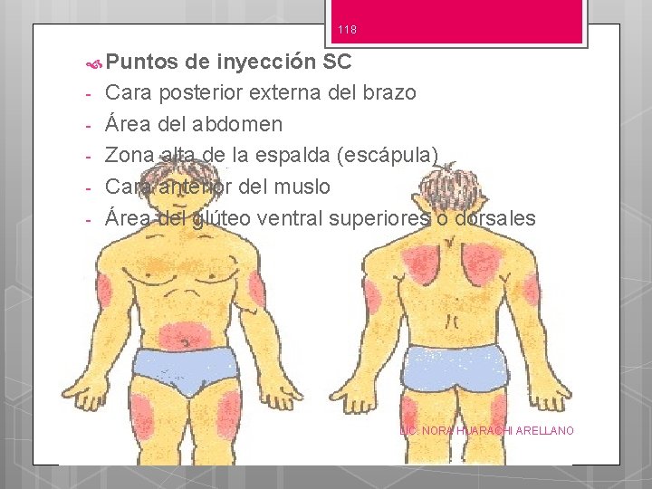 118 Puntos - de inyección SC Cara posterior externa del brazo Área del abdomen