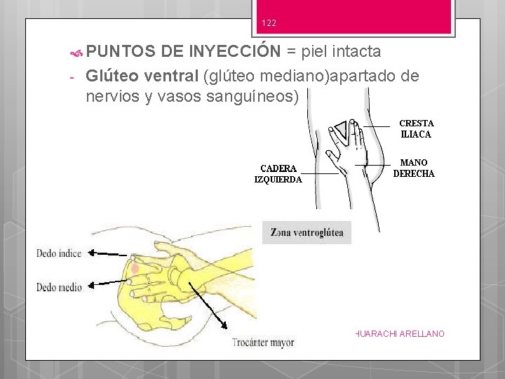 122 PUNTOS - DE INYECCIÓN = piel intacta Glúteo ventral (glúteo mediano)apartado de nervios