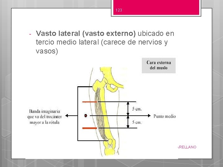 123 - Vasto lateral (vasto externo) ubicado en tercio medio lateral (carece de nervios