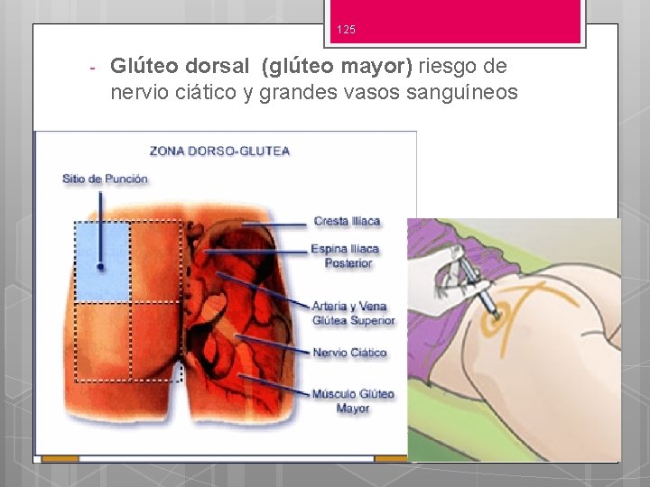 125 - Glúteo dorsal (glúteo mayor) riesgo de nervio ciático y grandes vasos sanguíneos