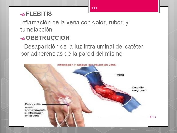 143 FLEBITIS Inflamación de la vena con dolor, rubor, y tumefacción OBSTRUCCION - Desaparición