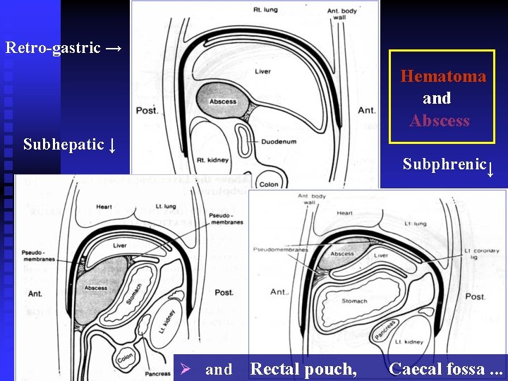 Retro-gastric → Hematoma and Abscess Subhepatic ↓ Subphrenic↓ Ø and Rectal pouch, Caecal fossa. Retro-gastric → Hematoma and Abscess Subhepatic ↓ Subphrenic↓ Ø and Rectal pouch, Caecal fossa.