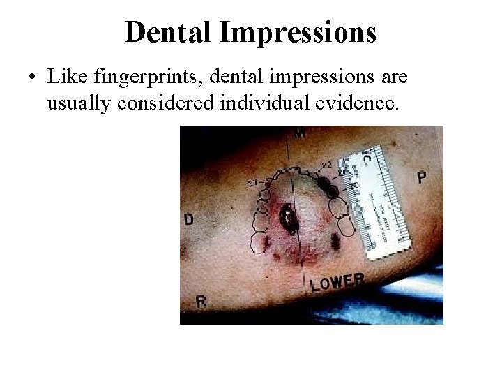 Dental Impressions • Like fingerprints, dental impressions are usually considered individual evidence. 