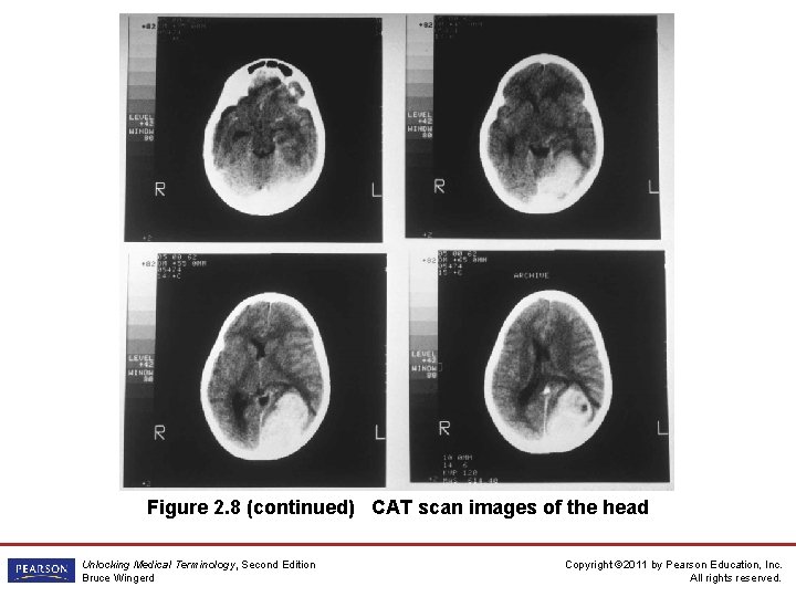 Figure 2. 8 (continued) CAT scan images of the head Unlocking Medical Terminology, Second