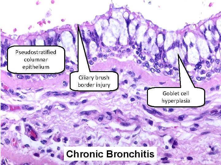 Pseudostratified columnar epithelium Ciliary brush border injury Goblet cell hyperplasia Chronic Bronchitis 