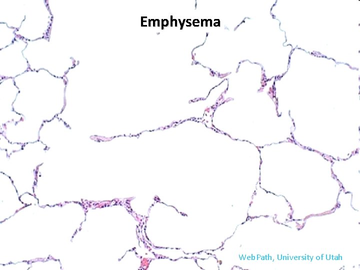 Emphysema Web. Path, University of Utah 