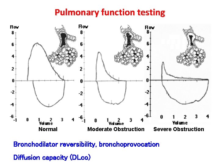 Pulmonary function testing Normal Moderate Obstruction Severe Obstruction Bronchodilator reversibility, bronchoprovocation Diffusion capacity (DLco)