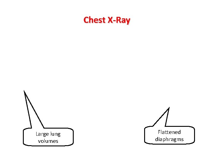 Chest X-Ray Large lung volumes Flattened diaphragms 