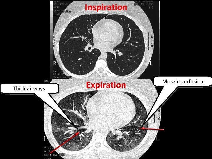 Inspiration Thick airways Expiration Mosaic perfusion 