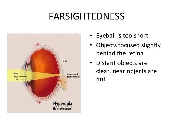 FARSIGHTEDNESS • Eyeball is too short • Objects focused slightly behind the retina •