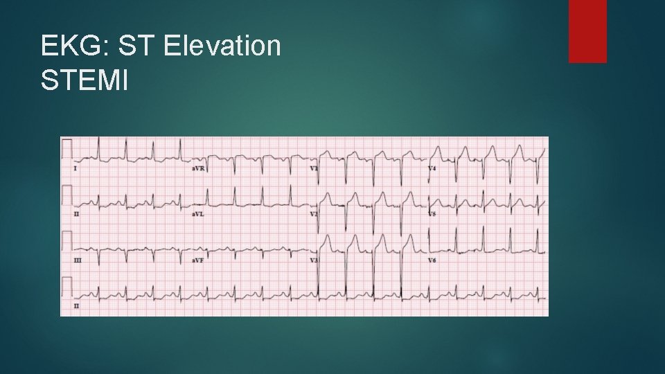 EKG: ST Elevation STEMI 