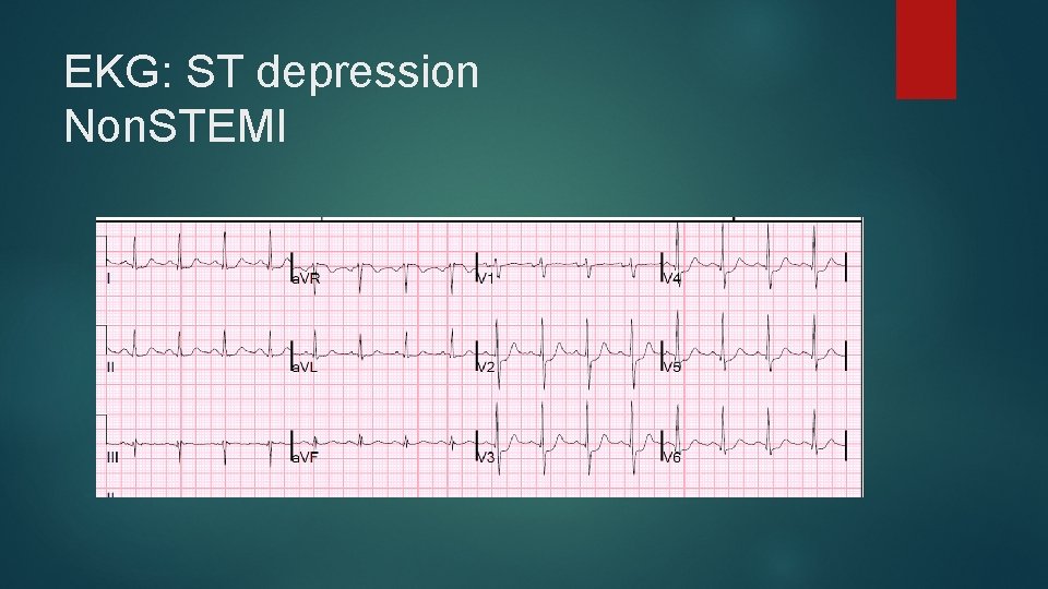 EKG: ST depression Non. STEMI 