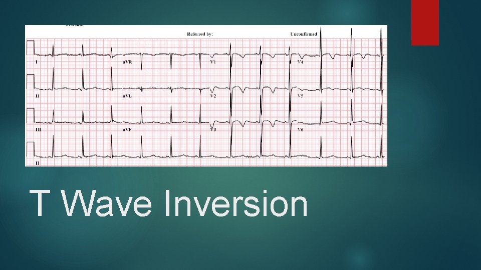 T Wave Inversion 