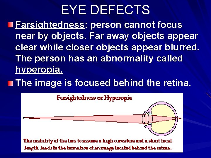 EYE DEFECTS Farsightedness: person cannot focus near by objects. Far away objects appear clear