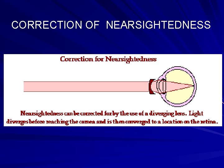 CORRECTION OF NEARSIGHTEDNESS 