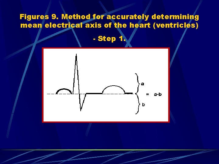 Figures 9. Method for accurately determining mean electrical axis of the heart (ventricles) -