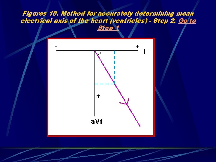 Figures 10. Method for accurately determining mean electrical axis of the heart (ventricles) -