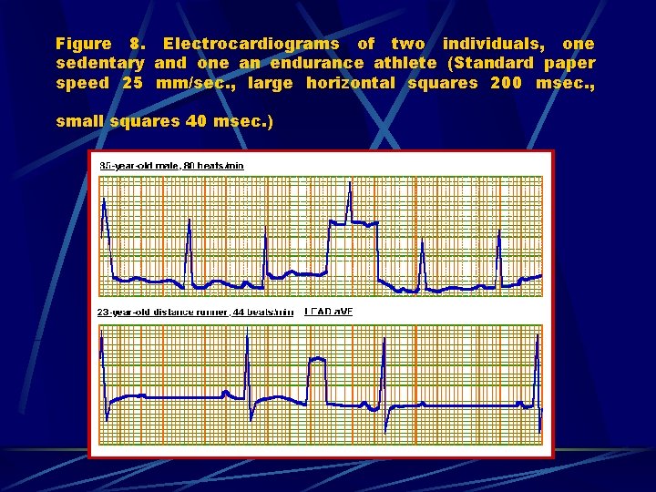 Figure 8. Electrocardiograms of two individuals, one sedentary and one an endurance athlete (Standard