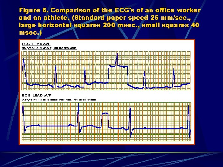 Figure 6. Comparison of the ECG's of an office worker and an athlete. (Standard