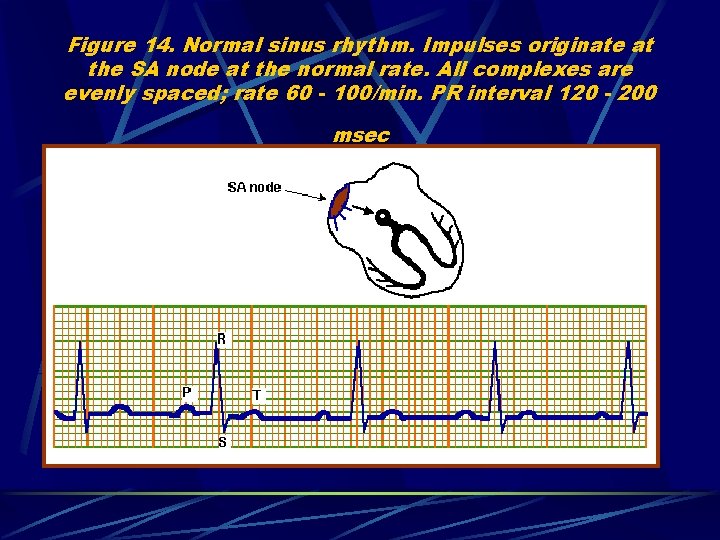 Figure 14. Normal sinus rhythm. Impulses originate at the SA node at the normal