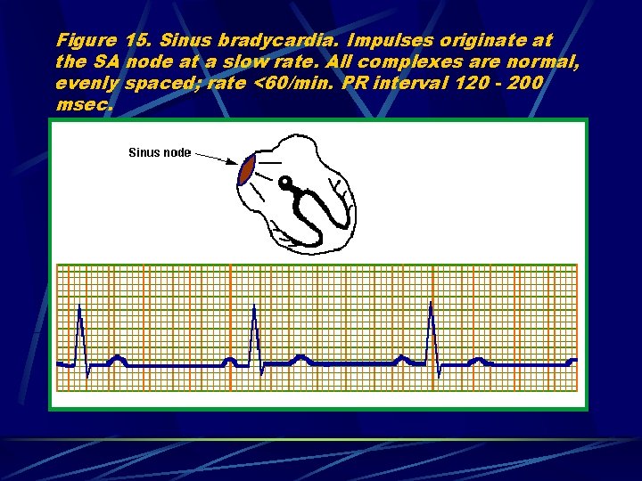 Figure 15. Sinus bradycardia. Impulses originate at the SA node at a slow rate.