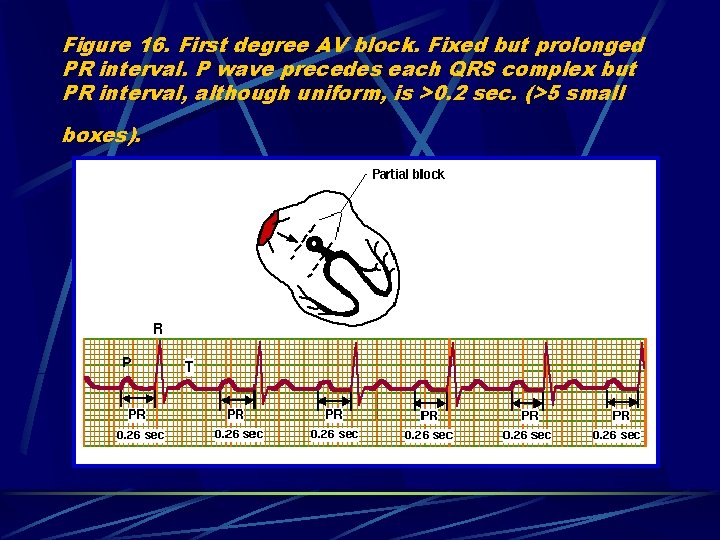 Figure 16. First degree AV block. Fixed but prolonged PR interval. P wave precedes