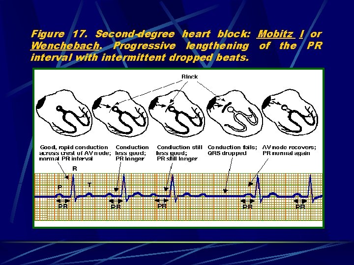 Figure 17. Second-degree heart block: Mobitz I or Wenchebach. Progressive lengthening of the PR