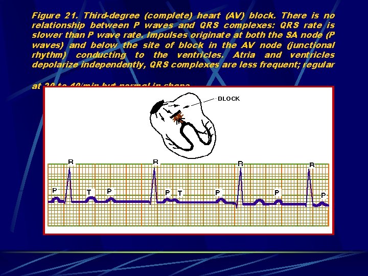 Figure 21. Third-degree (complete) heart (AV) block. There is no relationship between P waves