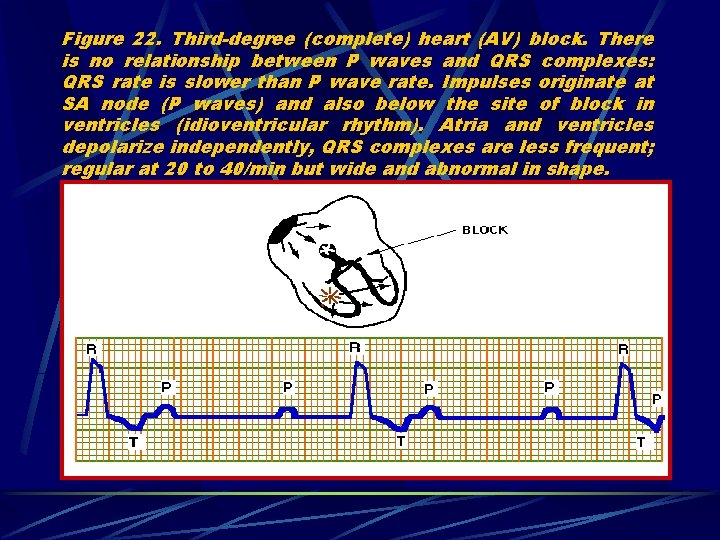 Figure 22. Third-degree (complete) heart (AV) block. There is no relationship between P waves