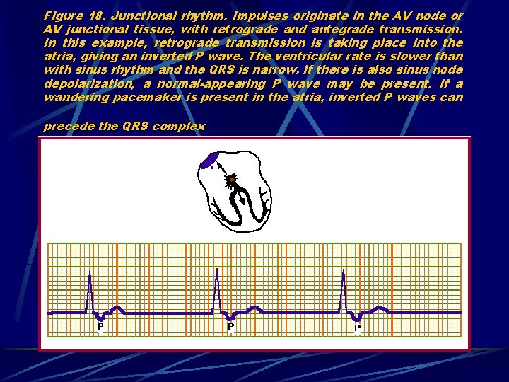 Figure 18. Junctional rhythm. Impulses originate in the AV node or AV junctional tissue,