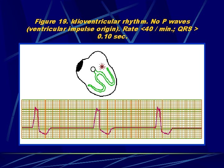 Figure 19. Idioventricular rhythm. No P waves (ventricular impulse origin). Rate <40 / min.