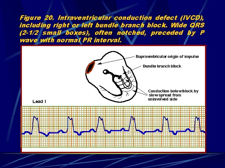 Figure 20. Intraventricular conduction defect (IVCD), including right or left bundle branch block. Wide