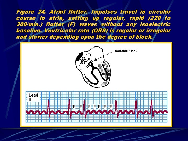 Figure 24. Atrial flutter. Impulses travel in circular course in atria, setting up regular,