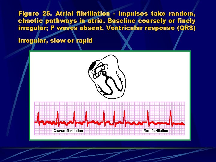 Figure 25. Atrial fibrillation - impulses take random, chaotic pathways in atria. Baseline coarsely