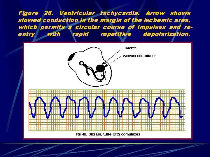 Figure 26. Ventricular tachycardia. Arrow shows slowed conduction in the margin of the ischemic