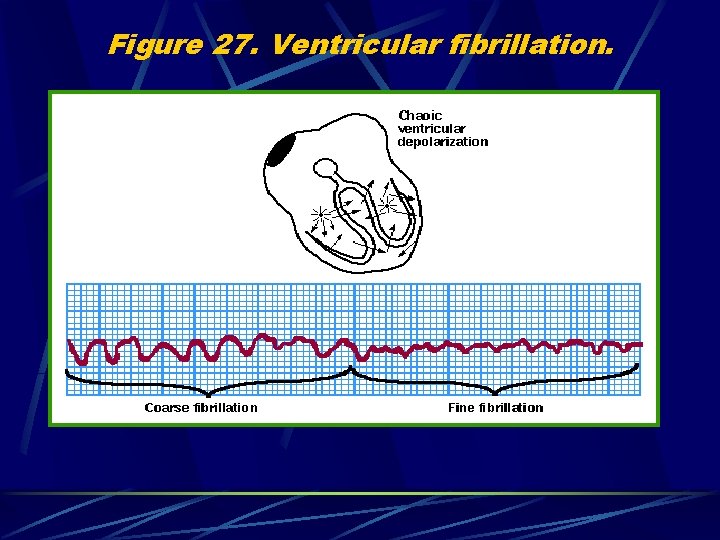 Figure 27. Ventricular fibrillation. 