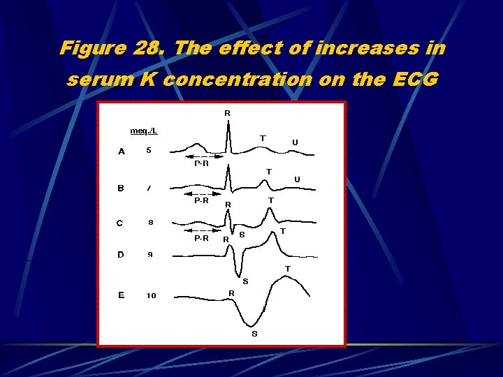 Figure 28. The effect of increases in serum K concentration on the ECG 