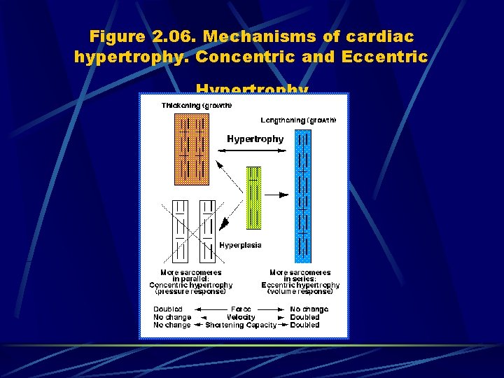 Figure 2. 06. Mechanisms of cardiac hypertrophy. Concentric and Eccentric Hypertrophy 