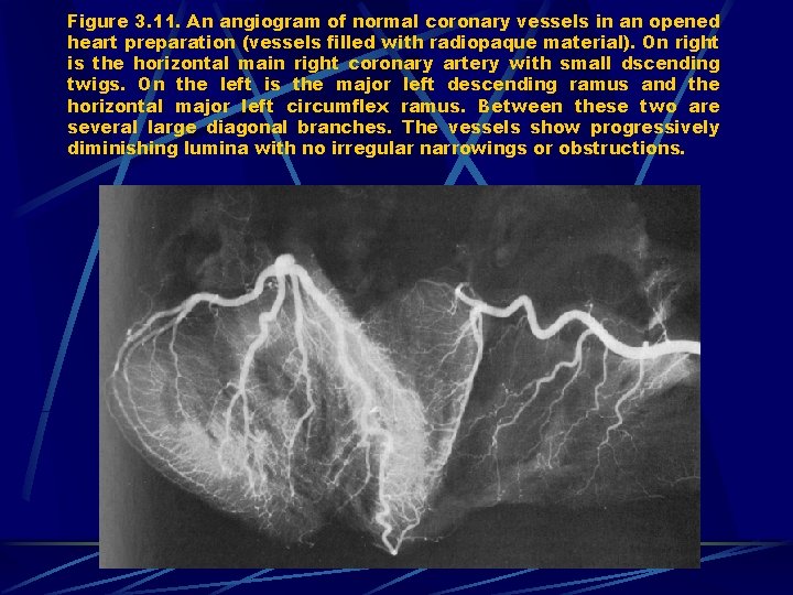 Figure 3. 11. An angiogram of normal coronary vessels in an opened heart preparation