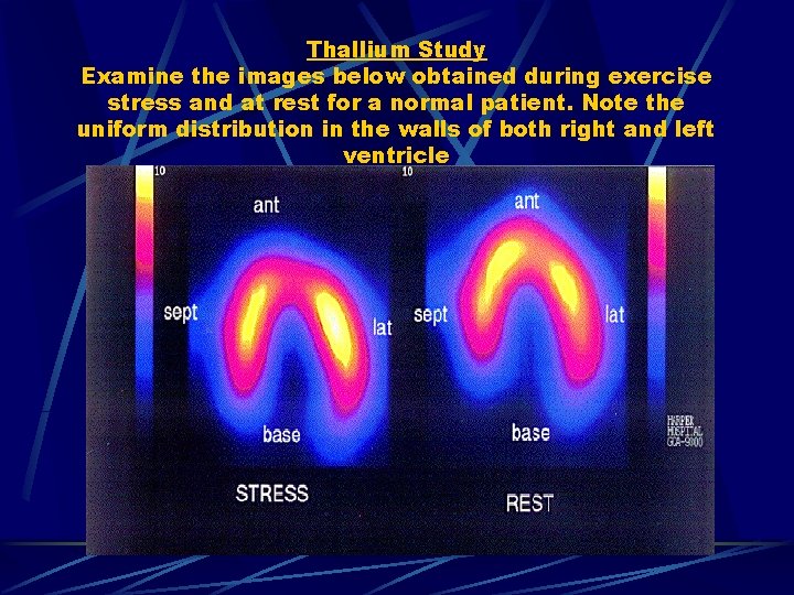 Thallium Study Examine the images below obtained during exercise stress and at rest for