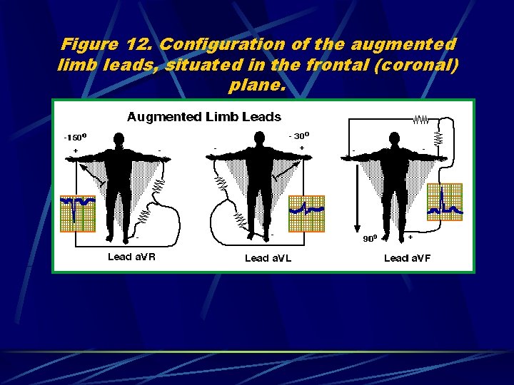 Figure 12. Configuration of the augmented limb leads, situated in the frontal (coronal) plane.